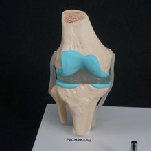Load image into Gallery viewer, Anatomical Human Degenerative Knee Joint Disease Model Medical Skeleton Anatomy Teaching Resources