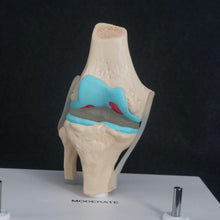 Load image into Gallery viewer, Anatomical Human Degenerative Knee Joint Disease Model Medical Skeleton Anatomy Teaching Resources