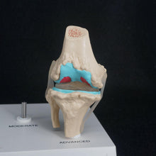 Load image into Gallery viewer, Anatomical Human Degenerative Knee Joint Disease Model Medical Skeleton Anatomy Teaching Resources