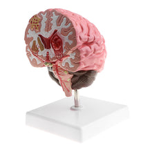 Load image into Gallery viewer, Anatomical Human's Brain Disease Pathological Model Medical Teaching Tool Lab Display Model School Educational Brain Model