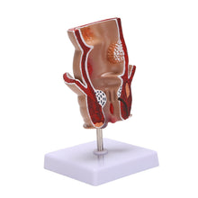 Load image into Gallery viewer, Anatomy Model Human Rectal Hemorrhoid Lesion Model Hemorrhoid Fistula Fistula Fissure Pathology Teaching Model