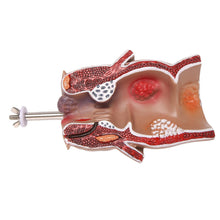 Load image into Gallery viewer, Human rectal haemorrhoid lesion model Haemorrhoidal fistula Fistula fissure Pathology teaching model
