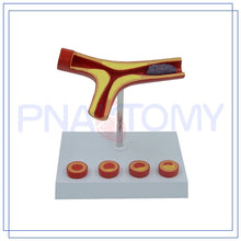 Load image into Gallery viewer, Arteriosclerosis Model with Thrombus for Human Artery Anatomical Model Blood Vessel Anatomy Medical Gift Teaching Tool