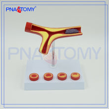 Load image into Gallery viewer, Arteriosclerosis Model with Thrombus for Human Artery Anatomical Model Blood Vessel Anatomy Medical Gift Teaching Tool