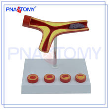Load image into Gallery viewer, Arteriosclerosis Model with Thrombus for Human Artery Anatomical Model Blood Vessel Anatomy Medical Gift Teaching Tool