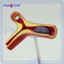 Load image into Gallery viewer, Arteriosclerosis Model with Thrombus for Human Artery Anatomical Model Blood Vessel Anatomy Medical Gift Teaching Tool