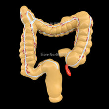 Load image into Gallery viewer, Colorectal lesion model human colon large intestine pathological diseases model medical organizer anatomy 14x17x21cm