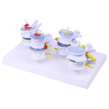 Load image into Gallery viewer, Medical props model 1 Set Human Lumbar Lesion Spine Statue Display Model Medical Teaching Learning Tool