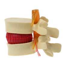 Load image into Gallery viewer, Medical props model Free postage Anatomical Spine Lumbar Disc Herniation Anatomy Medical Teaching Tool