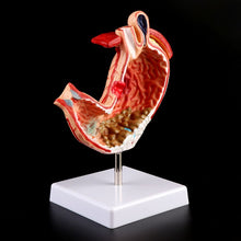 Load image into Gallery viewer, Human Anatomical Anatomy Stomach Medical Model Gastric Pathology Gastritis Ulcer Medical Teaching Learning Tool
