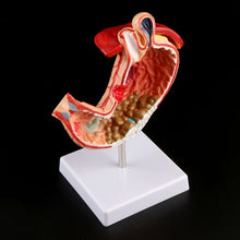 Load image into Gallery viewer, Human Anatomical Anatomy Stomach Medical Model Gastric Pathology Gastritis Ulcer Medical Teaching Learning Tool