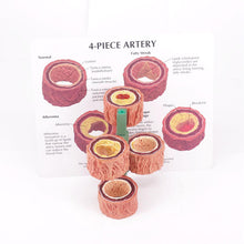 Load image into Gallery viewer, Human Atherosclerosis Model Thrombosis Model Artery Model Thrombosis Evolution Anatomy Medical Teaching Tool