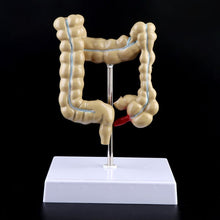 Load image into Gallery viewer, Human Colorectal Lesion Model Pathological Anatomy Colon Diseases Intestine Medical Teaching Learning Tool