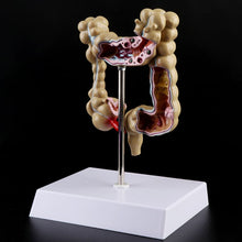 Load image into Gallery viewer, Human Colorectal Lesion Model Pathological Anatomy Colon Diseases Intestine Medical Teaching Learning Tool