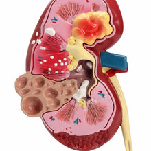 Load image into Gallery viewer, Kidney Pathologies Model Human Body Anatomy Replica of Diseased Kidney for Doctors Office Educational Tool GPI Anatomicals