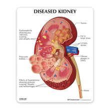 Load image into Gallery viewer, Kidney Pathology Model Human Anatomy Pathological Kidney Model for Physician's Office Educational Tool GPI Anatomy