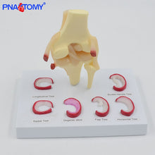 Load image into Gallery viewer, Life Size Knee Joint Model with Ligaments Shows Meniscus Tears Medical Teaching Tool Anatomical Model Skeleton Anatomy Toy