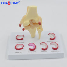 Load image into Gallery viewer, Life Size Knee Joint Model with Ligaments Shows Meniscus Tears Medical Teaching Tool Anatomical Model Skeleton Anatomy Toy