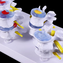Load image into Gallery viewer, Medical props model 1 Set Human Lumbar Lesion Spine Statue Display Model Medical Teaching Learning Tool