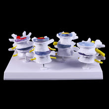 Load image into Gallery viewer, Medical props model 1 Set Human Lumbar Lesion Spine Statue Display Model Medical Teaching Learning Tool