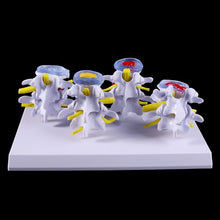 Load image into Gallery viewer, Medical props model 1 Set Human Lumbar Lesion Spine Statue Display Model Medical Teaching Learning Tool