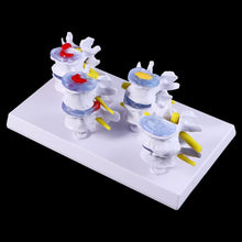 Load image into Gallery viewer, Medical props model 1 Set Human Lumbar Lesion Spine Statue Display Model Medical Teaching Learning Tool