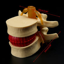 Load image into Gallery viewer, Medical props model Free postage Anatomical Spine Lumbar Disc Herniation Anatomy Medical Teaching Tool