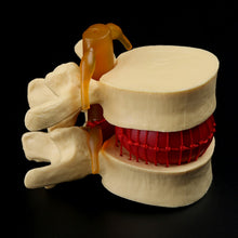 Load image into Gallery viewer, Medical props model Free postage Anatomical Spine Lumbar Disc Herniation Anatomy Medical Teaching Tool