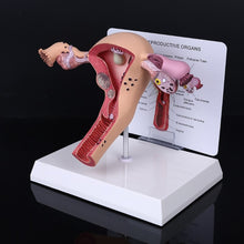 Load image into Gallery viewer, Medical props model Human Female Pathological Uterus Ovary Model Anatomical Disease Pathology Medical Lesion ForBiology Teaching