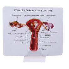 Load image into Gallery viewer, Medical props model Human Female Pathological Uterus Ovary Model Anatomical Disease Pathology Medical Lesion ForBiology Teaching