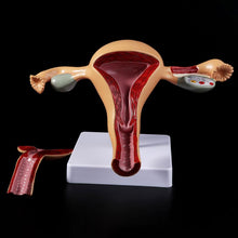 Load image into Gallery viewer, Medical props model Human Pathological Uterus Ovary Model Anatomical Anatomy Disease Pathology Medical Lesion For Teaching