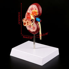 Load image into Gallery viewer, Medical props model Life Size Human Kidney Diseased Model Anatomical Anatomy Diseased Pathological Stone Organ Teaching Supplies