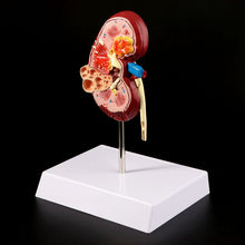 Load image into Gallery viewer, Medical props model Life Size Human Kidney Diseased Model Anatomical Anatomy Diseased Pathological Stone Organ Teaching Supplies