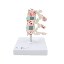 Load image into Gallery viewer, Human Body Model Bone Osteoporosis Lesion Model Spine Cervical Vertebra Displane Model Joint Model Bone Model