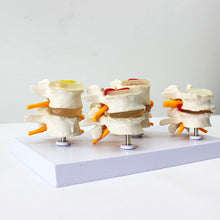 Load image into Gallery viewer, Human Anatomy Skeleton Spine 4-Stages Lumbar Vertebral Model Brain Skull Traumatic Medical Teaching Supplies