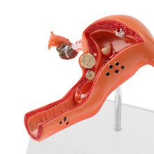 Load image into Gallery viewer, Pathological Uterus and Ovary Anatomical Model - Human Female Medical Anatomy