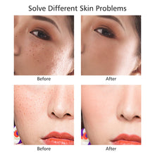 Load image into Gallery viewer, Pen Salon Plasma Pen Black Dots Vacuum Cleaner Laser Freckle Removal Machine Skin Mole Dark Spot Face Wart Tag Tattoo Remover