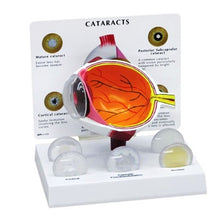Load image into Gallery viewer, 4X Human Pvc Eye Cataract Anatomy Medical Teaching Model
