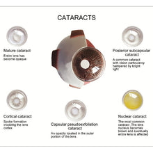Load image into Gallery viewer, 4X Human Pvc Eye Cataract Anatomy Medical Teaching Model
