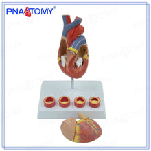 Load image into Gallery viewer, KX-A401 Heart Model 4-Stage Vascular Artery Pathological Stage Cardiac Anatomy Cardiovascular Education Mold
