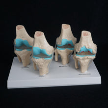 Load image into Gallery viewer, Anatomical Human Degenerative Knee Joint Disease Model Medical Skeleton Anatomy Teaching Resources
