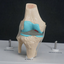Load image into Gallery viewer, Anatomical Human Degenerative Knee Joint Disease Model Medical Skeleton Anatomy Teaching Resources
