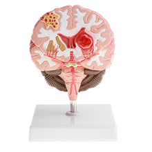 Load image into Gallery viewer, Anatomical Human's Brain Disease Pathological Model Medical Teaching Tool Lab Display Model School Educational Brain Model
