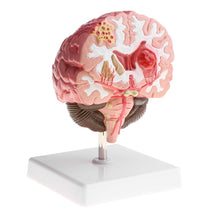 Load image into Gallery viewer, Anatomical Human's Brain Disease Pathological Model Medical Teaching Tool Lab Display Model School Educational Brain Model
