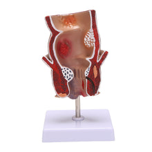 Load image into Gallery viewer, Anatomy Model Human Rectal Hemorrhoid Lesion Model Hemorrhoid Fistula Fistula Fissure Pathology Teaching Model
