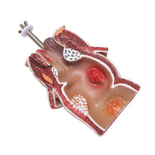 Load image into Gallery viewer, Anatomy Model Human Rectal Hemorrhoid Lesion Model Hemorrhoid Fistula Fistula Fissure Pathology Teaching Model
