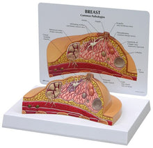 Load image into Gallery viewer, Breast Disease Breast Anatomy Model Human Body Model Anatomical Human Pathological Breast Model Medical Disease &amp; Cancer Anatomy
