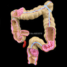 Load image into Gallery viewer, Colorectal lesion model human colon large intestine pathological diseases model medical organizer anatomy 14x17x21cm
