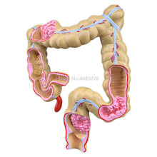 Load image into Gallery viewer, Colorectal lesion model human colon large intestine pathological diseases model medical organizer anatomy 14x17x21cm
