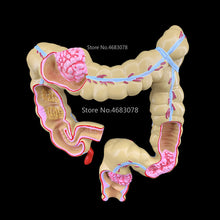 Load image into Gallery viewer, Colorectal lesion model human colon large intestine pathological diseases model medical organizer anatomy 14x17x21cm
